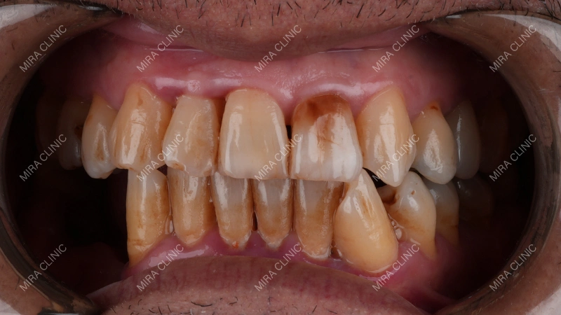 Missing Teeth
